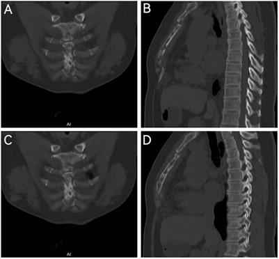 Case report: A case of intercostal intramuscular hemangioma with sternal invasion